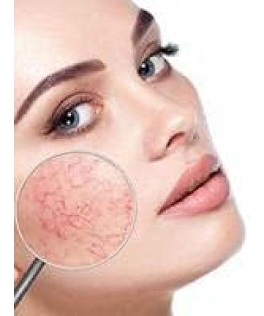 Couperose Face Serum Against Red Veins Rosacea Made in Germany 30ml - by Elaine Perine Made in Germany - Buy Online on GoSupps.com
