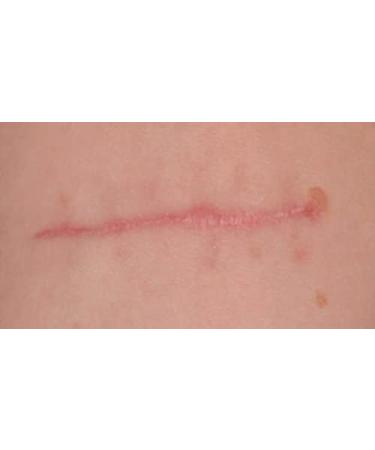 Scars Cocktail - Sterile Microneedling Serum for Derma Pen & Dermaroller | 5ml Professional Treatment - Buy Online on GoSupps.com
