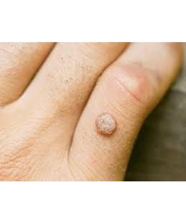 Naturasil Wart Remover - Fast-Acting All-Natural Liquid | Painless & Acid-Free | Made in USA - Buy Online on GoSupps.com
