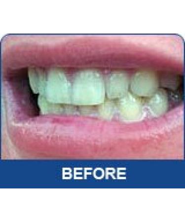 Professional Strength 36% Carbamide Peroxide Teeth Whitening Gel - 30cc Syringes (No Trays) | Includes Shade Card - Instant White Smile - Buy Online on GoSupps.com