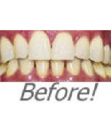 Professional Strength 36% Carbamide Peroxide Teeth Whitening Gel - 30cc Syringes (No Trays) | Includes Shade Card - Instant White Smile - Buy Online on GoSupps.com