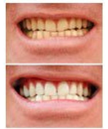 Professional Strength 36% Carbamide Peroxide Teeth Whitening Gel - 30cc Syringes (No Trays) | Includes Shade Card - Instant White Smile - Buy Online on GoSupps.com