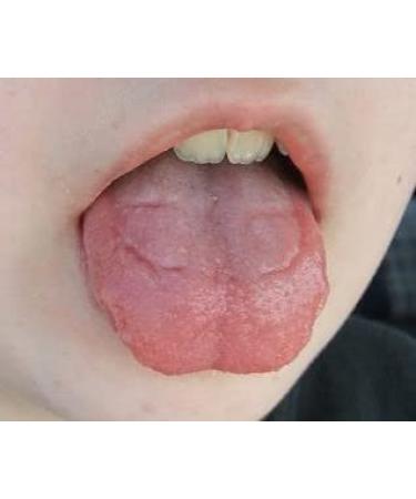 RPE Tongue Guard - Prevents and Heals Tongue Sores from Dental Expanders - Buy Online on GoSupps.com