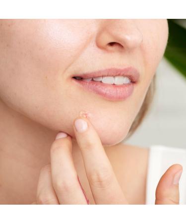 Origins Super Spot Remover Acne Treatment Gel with Salicylic Acid 0.3 oz - Discover Premium Quality Shop now! - Buy Online on GoSupps.com