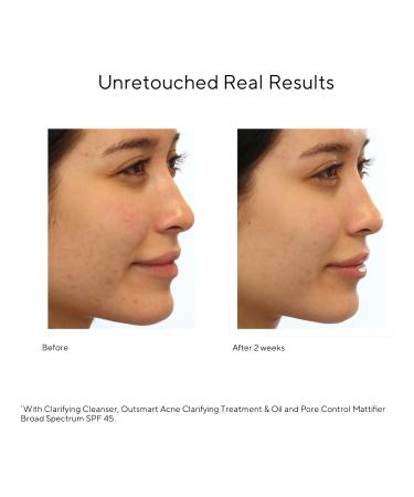Discover Murad Outsmart Acne Clarifying Treatment 1.7 oz - Elevate Your Style Instantly! - Buy Online on GoSupps.com