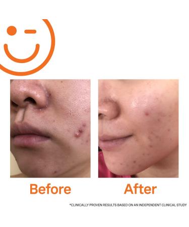 Kate Somerville EradiKate 3% Sulfur Daily Foaming Cleanser + Acne Treatment 4.0 oz - Discover Premium Quality Shop now! - Buy Online on GoSupps.com