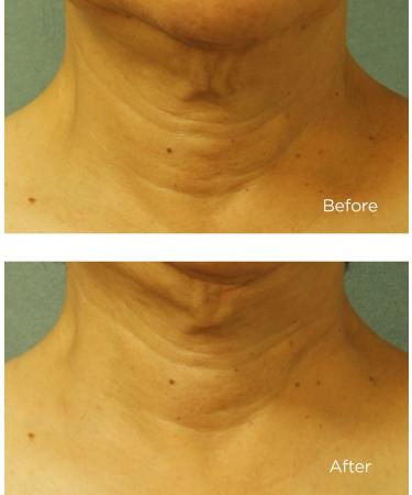 Perricone MD Cold Plasma Plus+ Neck & Chest Broad Spectrum SPF 25 1.0 oz - Transform Your Style with the Best Innovation Today! - Buy Online on GoSupps.com