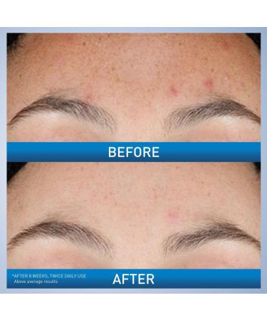 CeraVe Resurfacing Retinol Facial Serum for Acne Prone Skin 1.0 oz - Discover Premium Quality Shop now! - Buy Online on GoSupps.com