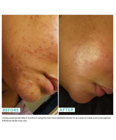 Urban Skin Rx Even Tone Essentials Starter Kit - Transform Your Style with the Best Innovation Today! - Buy Online on GoSupps.com