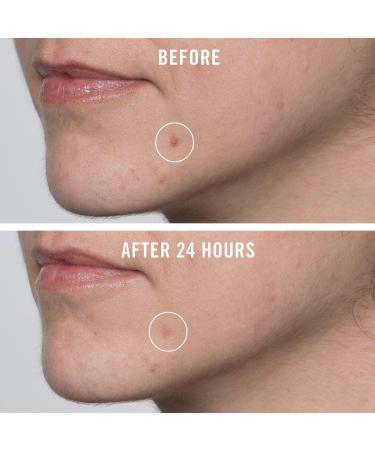 Discover First Aid Beauty FAB Pharma BHA Acne Spot Treatment 0.75 oz - Elevate Your Style Instantly! - Buy Online on GoSupps.com