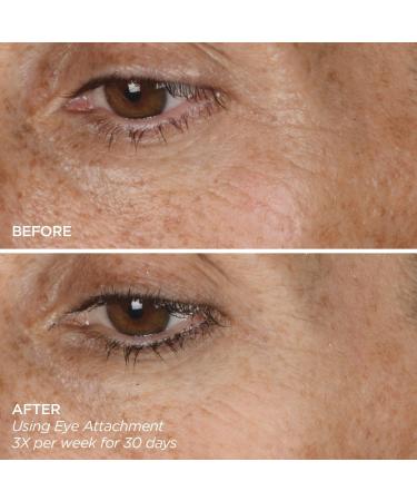 Discover BeautyBio GloPRO EYE MicroTip Attachment - Elevate Your Style Instantly! - Buy Online on GoSupps.com