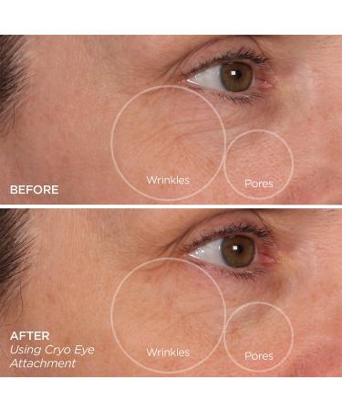 Discover BeautyBio GloPRO CRYO Roller Attachment Duo - Elevate Your Style Instantly! - Buy Online on GoSupps.com