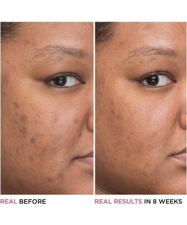 IT Cosmetics Bye Bye Dark Spots Niacinamide Serum 1.0 oz - Transform Your Style with the Best Innovation Today! - Buy Online on GoSupps.com