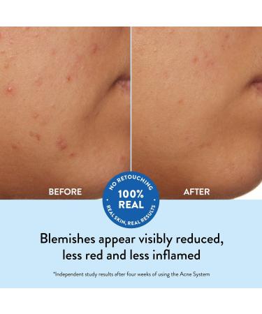 Peach Slices Acne Clarifying Cleanser 4.0 oz - Transform Your Style with the Best Innovation Today! - Buy Online on GoSupps.com
