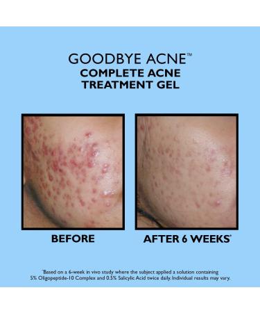 Peter Thomas Roth Goodbye Acne Complete Acne Treatment Gel 1.7 oz - Discover Premium Quality Shop now! - Buy Online on GoSupps.com