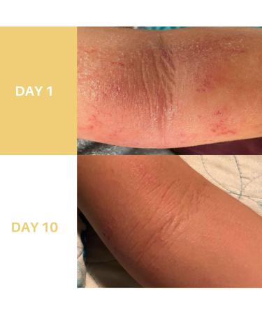 Eczema Honey Skin-Soothing Cream 4.0 oz - Discover Premium Quality Shop now! - Buy Online on GoSupps.com