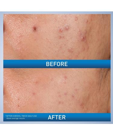 CeraVe Acne Control Gel Blemish Treatment with AHA & BHA for Acne Prone Skin 1.35 oz - Transform Your Style with the Best Innovation Today! - Buy Online on GoSupps.com