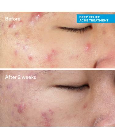Discover Murad Deep Relief Acne Treatment with Soothing Phytosteroid 1.0 oz - Elevate Your Style Instantly! - Buy Online on GoSupps.com