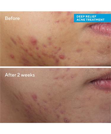 Discover Murad Deep Relief Acne Treatment with Soothing Phytosteroid 1.0 oz - Elevate Your Style Instantly! - Buy Online on GoSupps.com