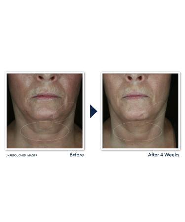 Discover RoC Derm Correxion Contour Cream for Face and Neck 1.7 oz - Elevate Your Style Instantly! - Buy Online on GoSupps.com