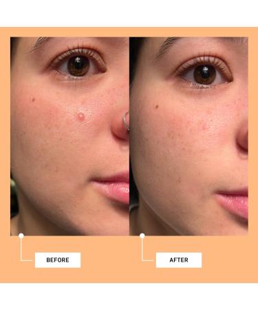 good light Luna Fast Acting Pimple Patches 24 ct - Transform Your Style with the Best Innovation Today! - Buy Online on GoSupps.com