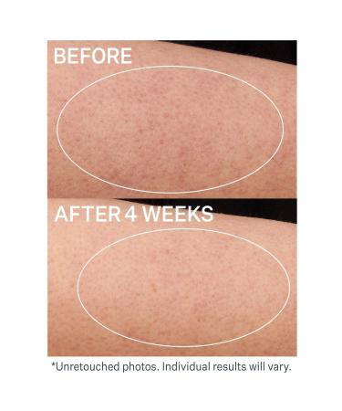 StriVectin KP Care Bump Exfoliating Body Scrub 5.0 oz - Transform Your Style with the Best Innovation Today! - Buy Online on GoSupps.com