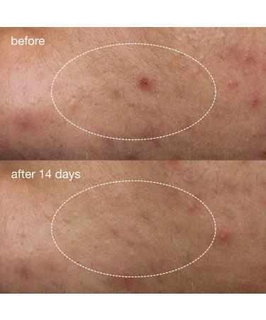 Dermalogica Deep Acne Invisible Liquid Patch 0.5 oz - Discover Premium Quality Shop now! - Buy Online on GoSupps.com