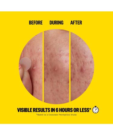 Discover Peace Out Salicylic Acid Sheer Acne Day Dots 40 ct ($38 value) - Elevate Your Style Instantly! - Buy Online on GoSupps.com