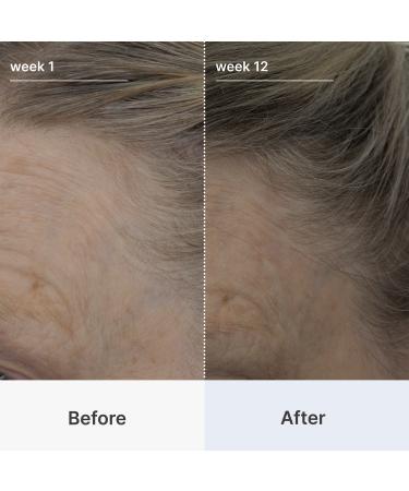 Better Not Younger Superpower Thickening Hairpatches 14 pair - Transform Your Style with the Best Innovation Today! - Buy Online on GoSupps.com