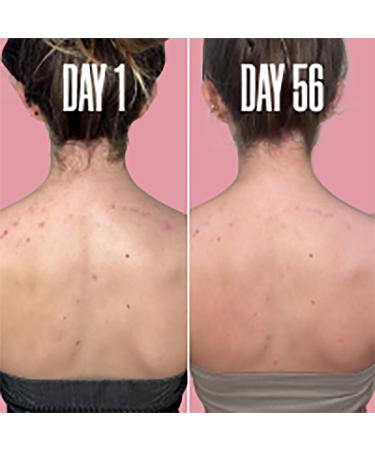 MAÃ‹LYS GET-BACK Targeted Body Acne Spray 3.38 oz - Transform Your Style with the Best Innovation Today! - Buy Online on GoSupps.com