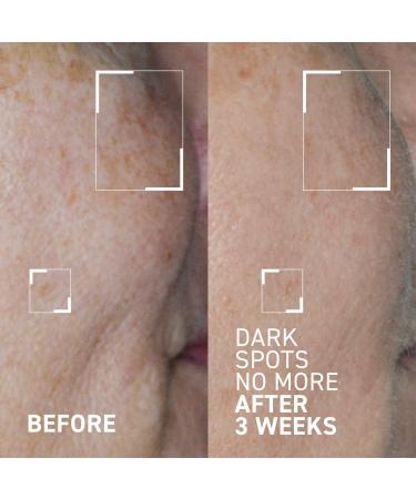 Dr. Brandt Bright This Way Dark Spots No More Triple Acid Spot Minimizing Concentrate 0.5 oz - Transform Your Style with the Best Innovation Today! - Buy Online on GoSupps.com