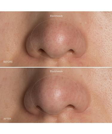 FOREO KIWI Blackhead Remover Pore Vacuum - Discover Premium Quality Shop now! - Buy Online on GoSupps.com