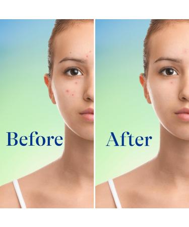 Differin Maximum Strength Acne Foaming Cleanser with 10% Benzoyl Peroxide 5.0 oz - Transform Your Style with the Best Innovation Today! - Buy Online on GoSupps.com