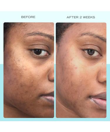 Discover First Aid Beauty Facial Radiance Niacinamide Dark Spot Serum 1.0 oz - Elevate Your Style Instantly! - Buy Online on GoSupps.com