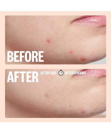 Peace Out Travel Size Salicylic Acid Acne Healing Dots 10 ct - Discover Premium Quality Shop now! - Buy Online on GoSupps.com