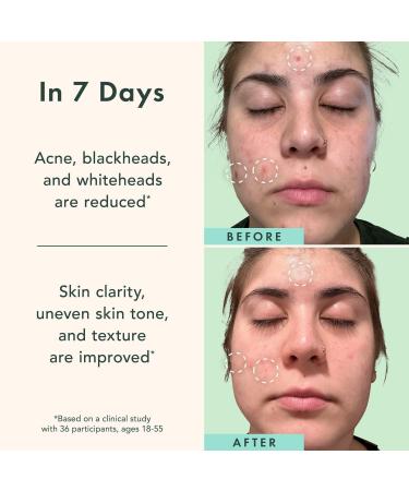 Discover Rael Miracle Clear Complete Acne Serum 1.0 oz - Elevate Your Style Instantly! - Buy Online on GoSupps.com