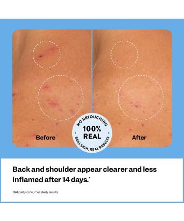 Discover Peach Slices Breakout Banisher Body Spray 4.0 oz - Elevate Your Style Instantly! - Buy Online on GoSupps.com