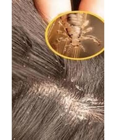 nature du monde PHARMA Lice Shampoo Treatment Anti-Lice & Sluggish. 100% based on natural active ingredients. Shampoo that cleans and removes 200 ml. - Buy Online on GoSupps.com