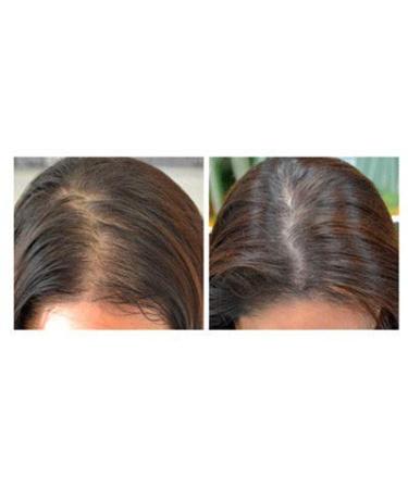 PROPIDEX Premium Hair Regrowth Treatment for Men & Women | Biotin & Saw Palmetto Formula to Prevent Hair Loss & Stimulate Follicles - Buy Online on GoSupps.com