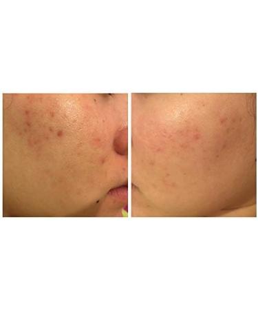 Avene Cicalfate Repair Cream Hypoallergenic for Sensitive & Irritated Skin 100 ml - Buy Online on GoSupps.com