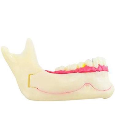 DYTAH Pathological Teeth Model - Right Oral Mandibular Communication for Medical Science - Buy Online on GoSupps.com