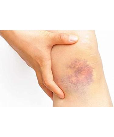 Thrombocid Ointment 30g - Relief for Bruises and Swelling - Buy Online on GoSupps.com