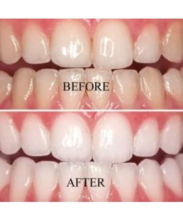 Natural Elegance Plus Mint Teeth Whitening Gel 2-Pack - 22% Carbamide Peroxide by Henry Schein | Reduced Sensitivity Formula | Compare to Opalescence Dramatic Professional Whitening - Buy Online on GoSupps.com