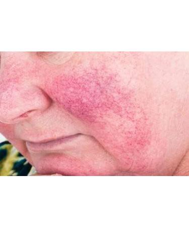 Wellmadefairtrade Herbalshire Sulphur Cream Natural Sulphur Ointment Cream Sulphur Acne Sulphur Body Cream 35g - Buy Online on GoSupps.com