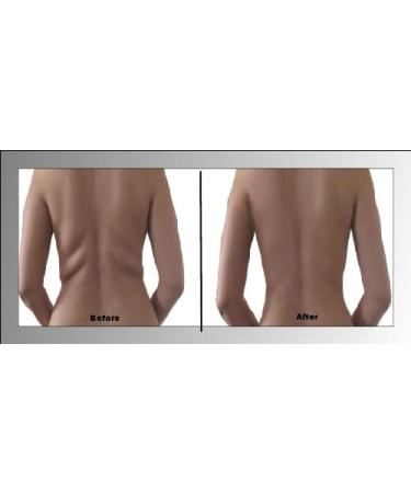 Skinnies Instant Lifts - 5 Pair Clear Adhesive Back Lifts | Patented, Made in USA | Instantly Smooth & Flatten Back Fat - Buy Online on GoSupps.com