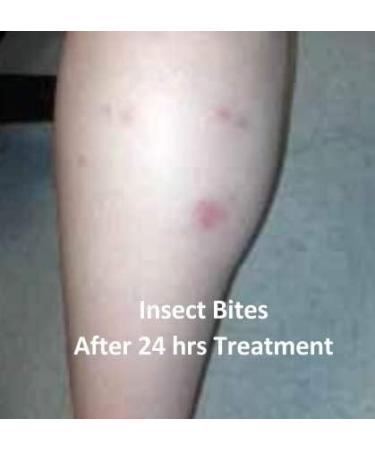 ECOLEAF Natural Insect Bite Stick 2 Pack | Organic Plant Extracts | USA Made for Pain & Itch Relief | Mosquito, Spider, Chiggers, Ants | 2 Count - Buy Online on GoSupps.com