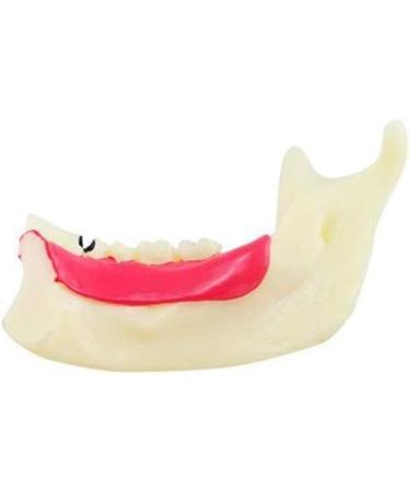 DYTAH Pathological Teeth Model - Right Oral Mandibular Communication for Medical Science - Buy Online on GoSupps.com