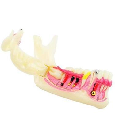 DYTAH Pathological Teeth Model - Right Oral Mandibular Communication for Medical Science - Buy Online on GoSupps.com