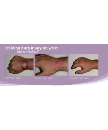 Intensive Scar Cream with Advanced Polymer Technology | Fade Old & New Scars Surgical Scars & Burns | Soothes Irritated Skin - 4 oz - Buy Online on GoSupps.com