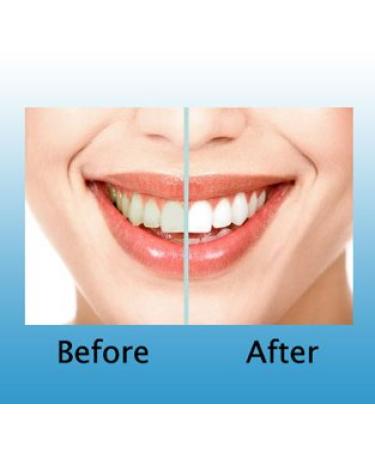 Teeth Whitening Kit with 44% Carbamide Peroxide Gel, LED Accelerator Light, Trays & Shade Guide - Buy Online on GoSupps.com